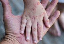 Puskesmas Leuwiliang Gelar Imunisasi Kejar Campak, Warga Diminta Segera Lengkapi Imunisasi Anak