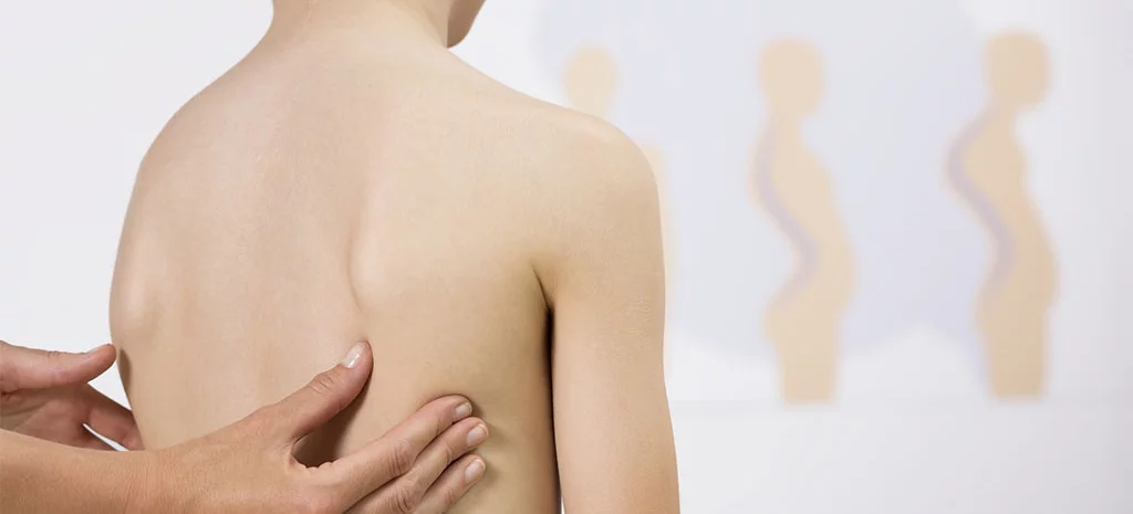 Treat your scoliosis now with our team of expert chiropractors