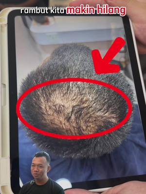 ⁣Dulu rambut makin hilang, sekarang rambut dah jadi lebat! #rambutgugur #botak #rambuttebal 