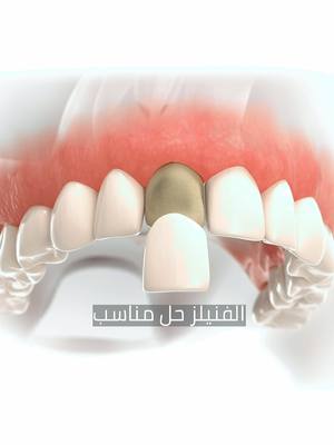 عدسات الأسنان ( الڤينير ) هتغير شكل ضحكتك 😎 الحصول على ?