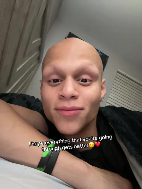 #alopecia #gxbrielpn 