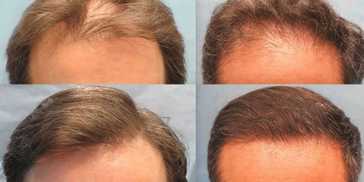 Know Everything About FUE Hair Transplantation