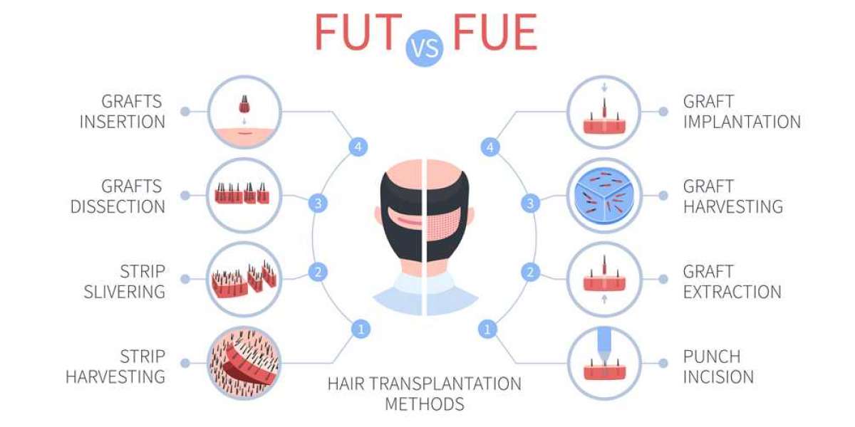 Fue vs Fut treatment