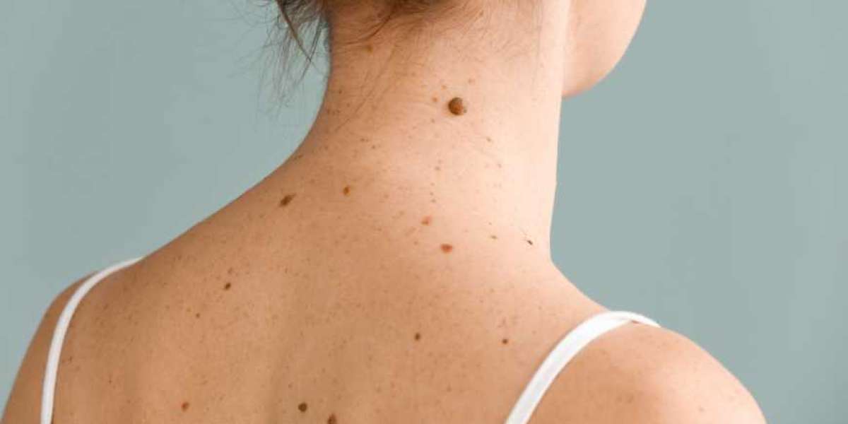 Everything you need to know before having a mole removed