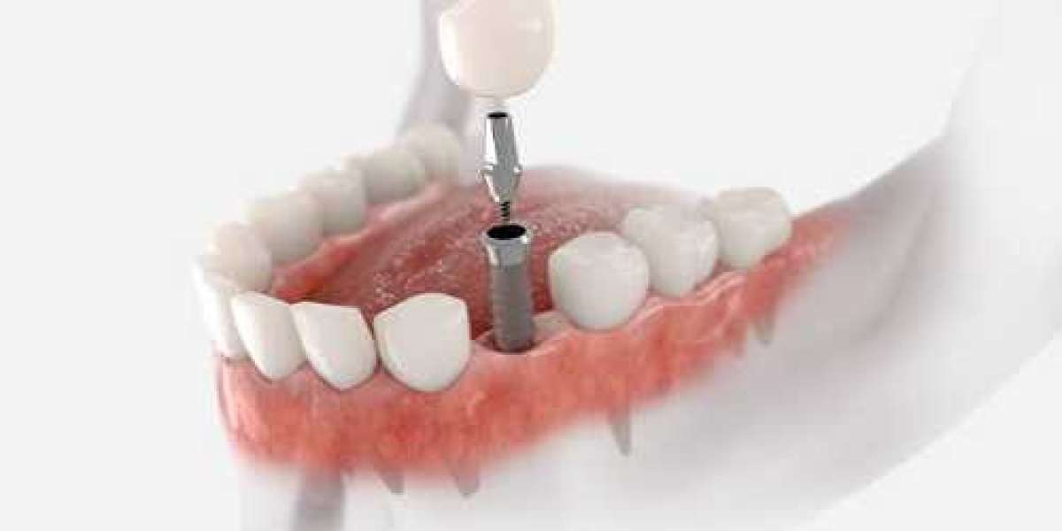 Dental Biomaterials Market Insight, Deep Research & Segment Analysis 2027