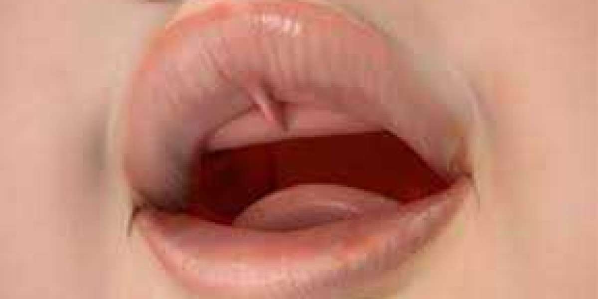 Top Reasons Why You Should Get Your Lip Tie treatment