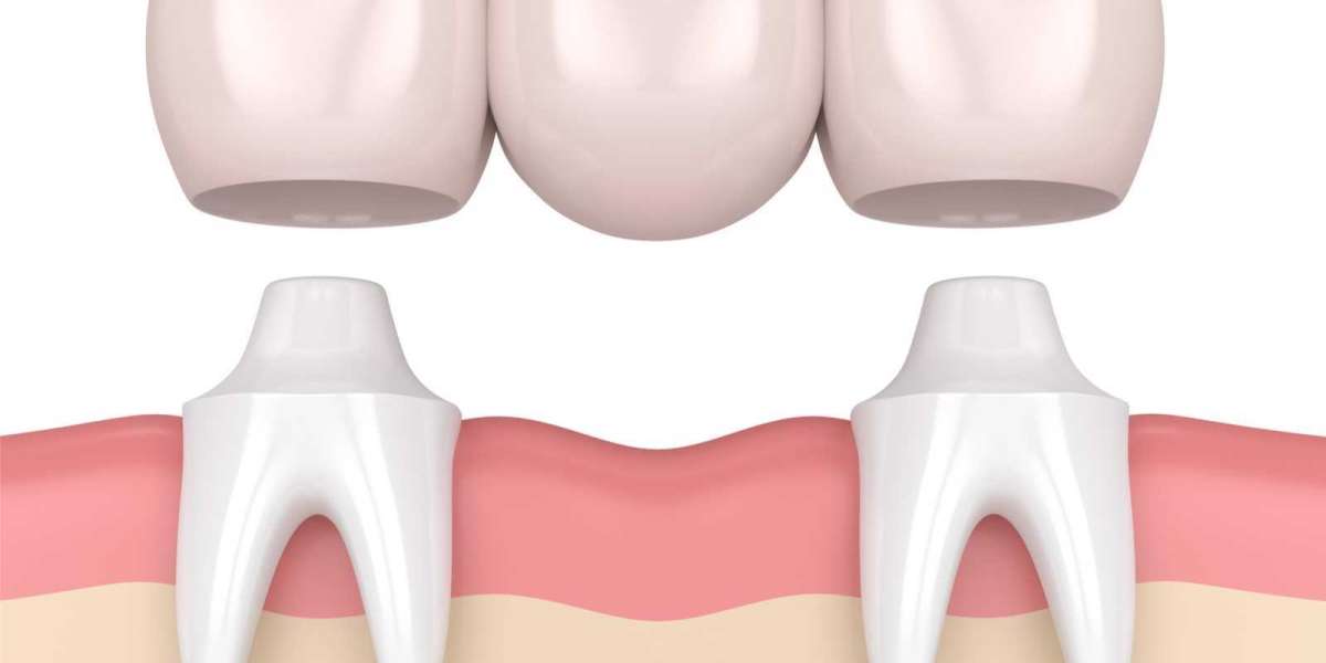 Dentistry with Crowns: What to Expect