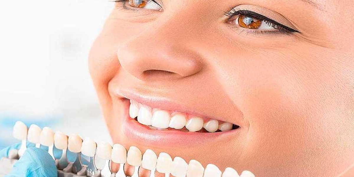 Understanding The Different Adhesive Options For Dental Veneers Services