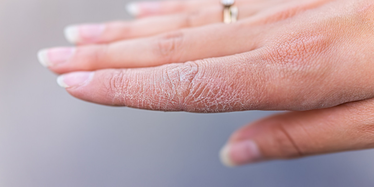 Eczema Therapeutics Market is Estimated to Witness High Growth