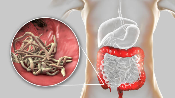 Best Treatment Of Parasitic Infections In the Body