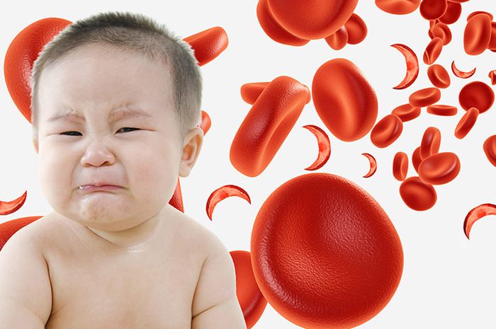 Kenali Anemia (Kekurangan Zat Besi) pada Anak