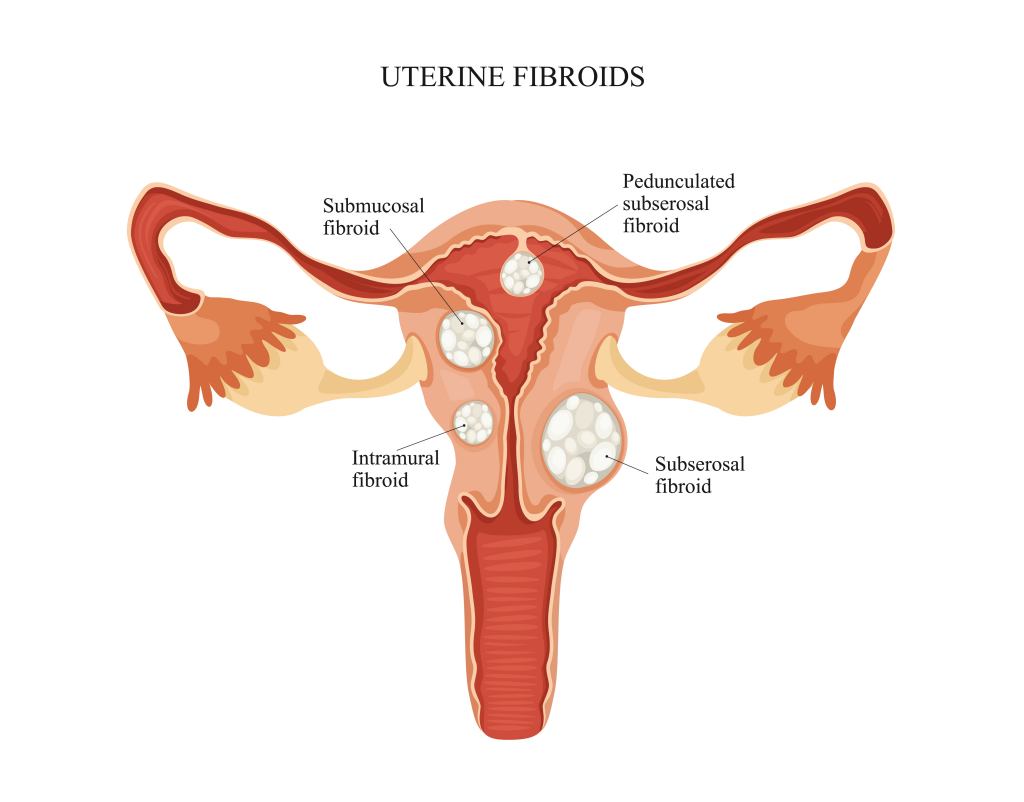 tumor-jinak-rahim-mioma