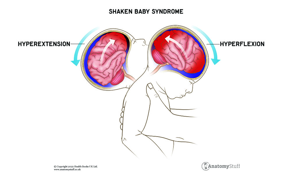 Hati-hati Shaken Baby Syndrome