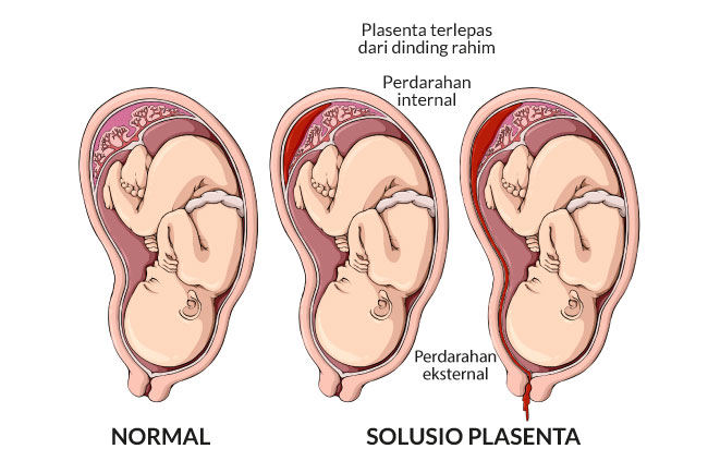 solusio-plasenta-plasenta-terlepas-dari-dinding-rahim