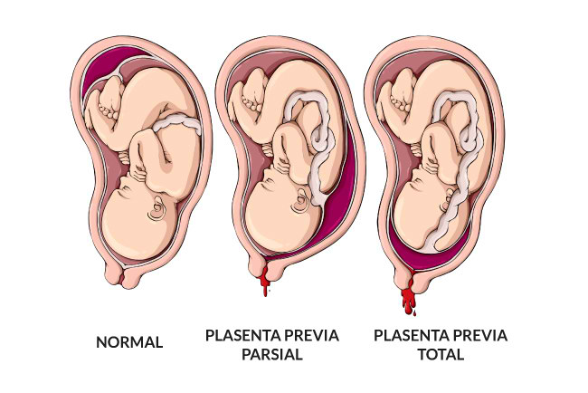 plasenta-menutupi-jalan-lahir-bisa-lahir-normal