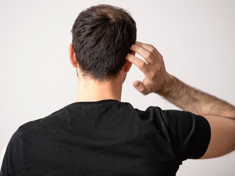 Atasi Ketombe dengan Anti Dandruff Treatment