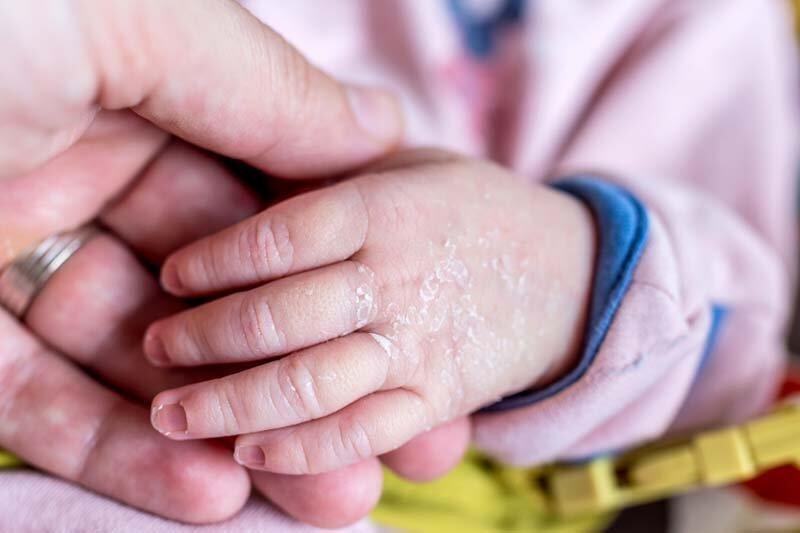Kulit Bayi Kering & Mengelupas: Penyebab, Cara Mengatasi, dan Perawatan Aman