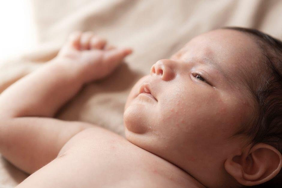 7 Ciri-Ciri Biang Keringat pada Bayi yang Perlu Bunda Kenali