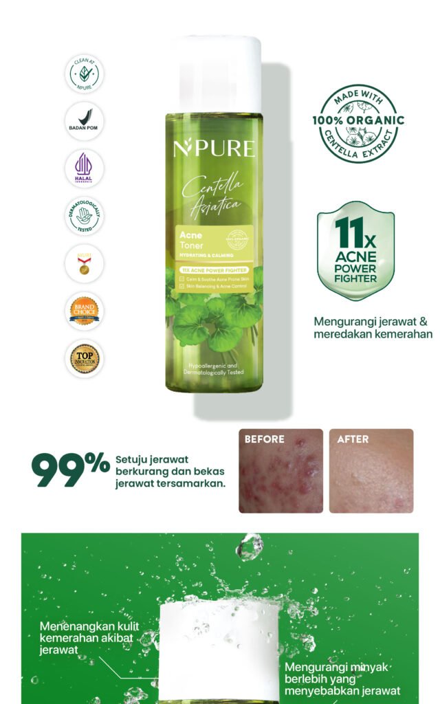 Toner kulit berjerawat NPURE Cica
